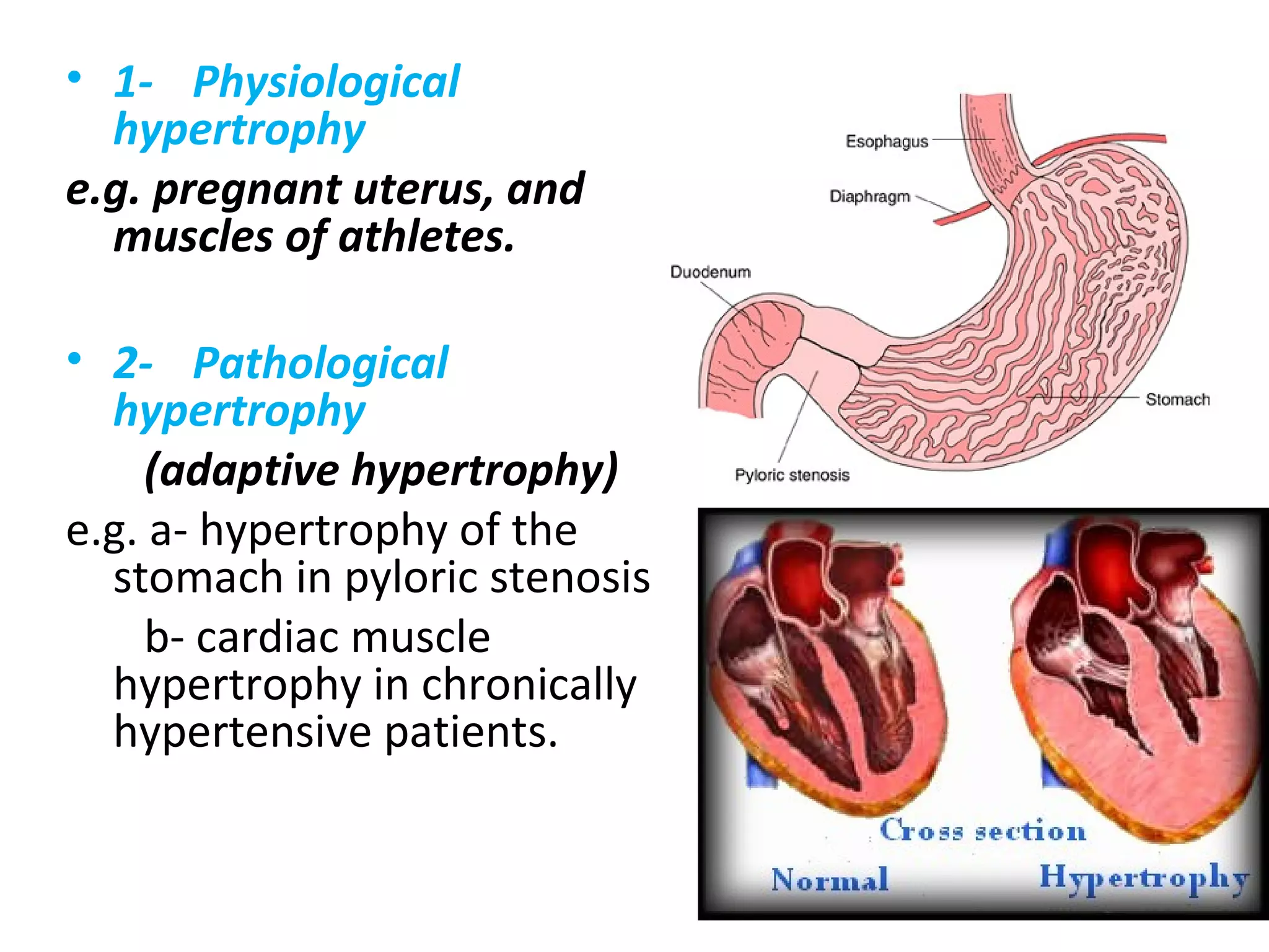 • 1- Physiological
hypertrophy
e.g. pregnant uterus, and
muscles of athletes.
• 2- Pathological
hypertrophy
(adaptive hypertrophy)
e.g. a- hypertrophy of the
stomach in pyloric stenosis
b- cardiac muscle
hypertrophy in chronically
hypertensive patients.
 
