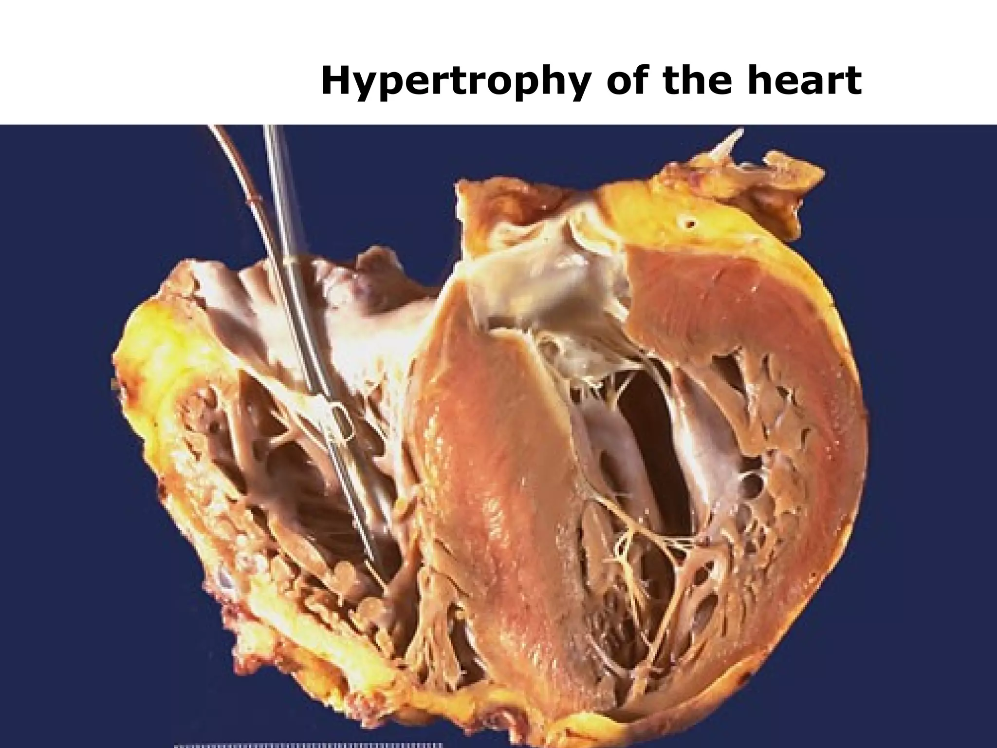 Hypertrophy of the heart
 