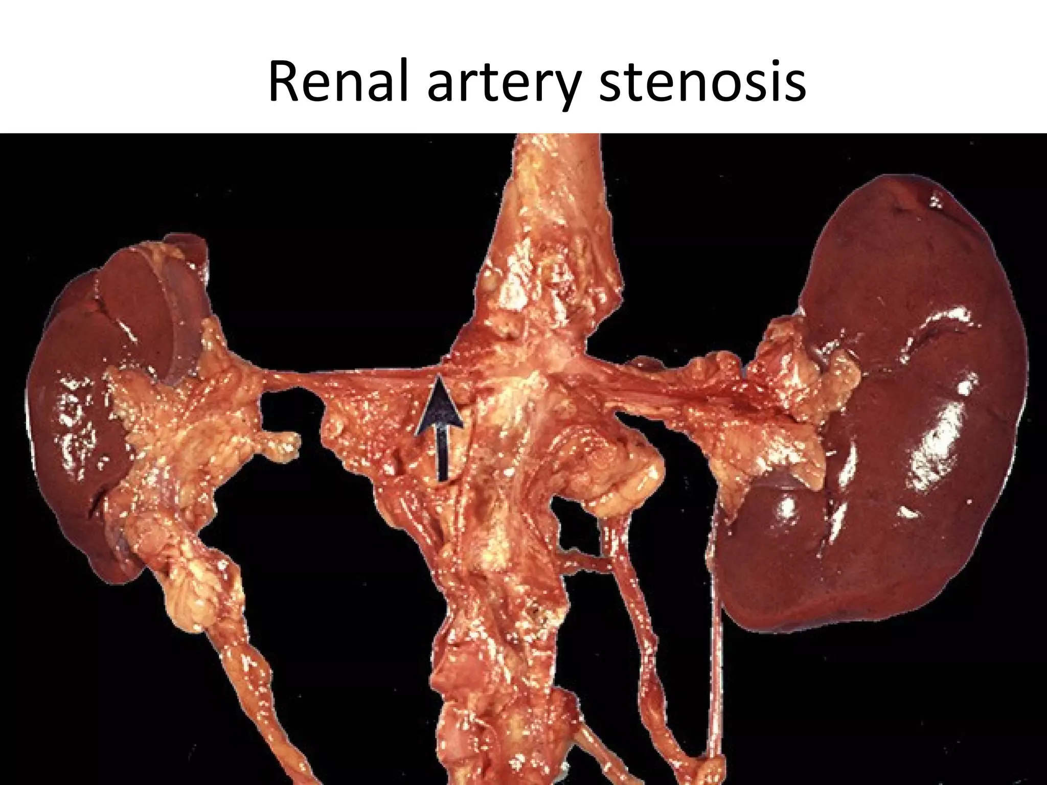 Renal artery stenosis
 