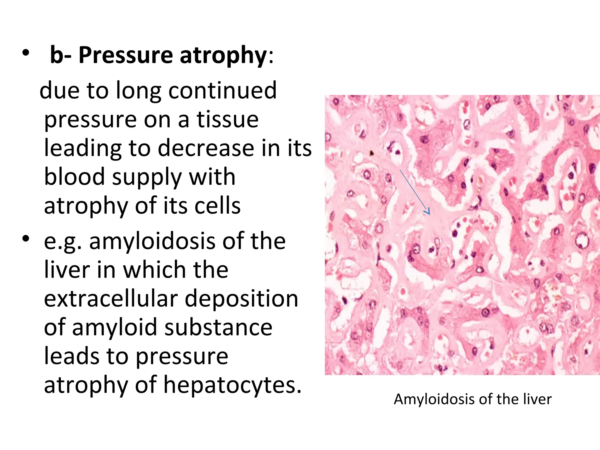 • b- Pressure atrophy:
due to long continued
pressure on a tissue
leading to decrease in its
blood supply with
atrophy of its cells
• e.g. amyloidosis of the
liver in which the
extracellular deposition
of amyloid substance
leads to pressure
atrophy of hepatocytes. Amyloidosis of the liver
 