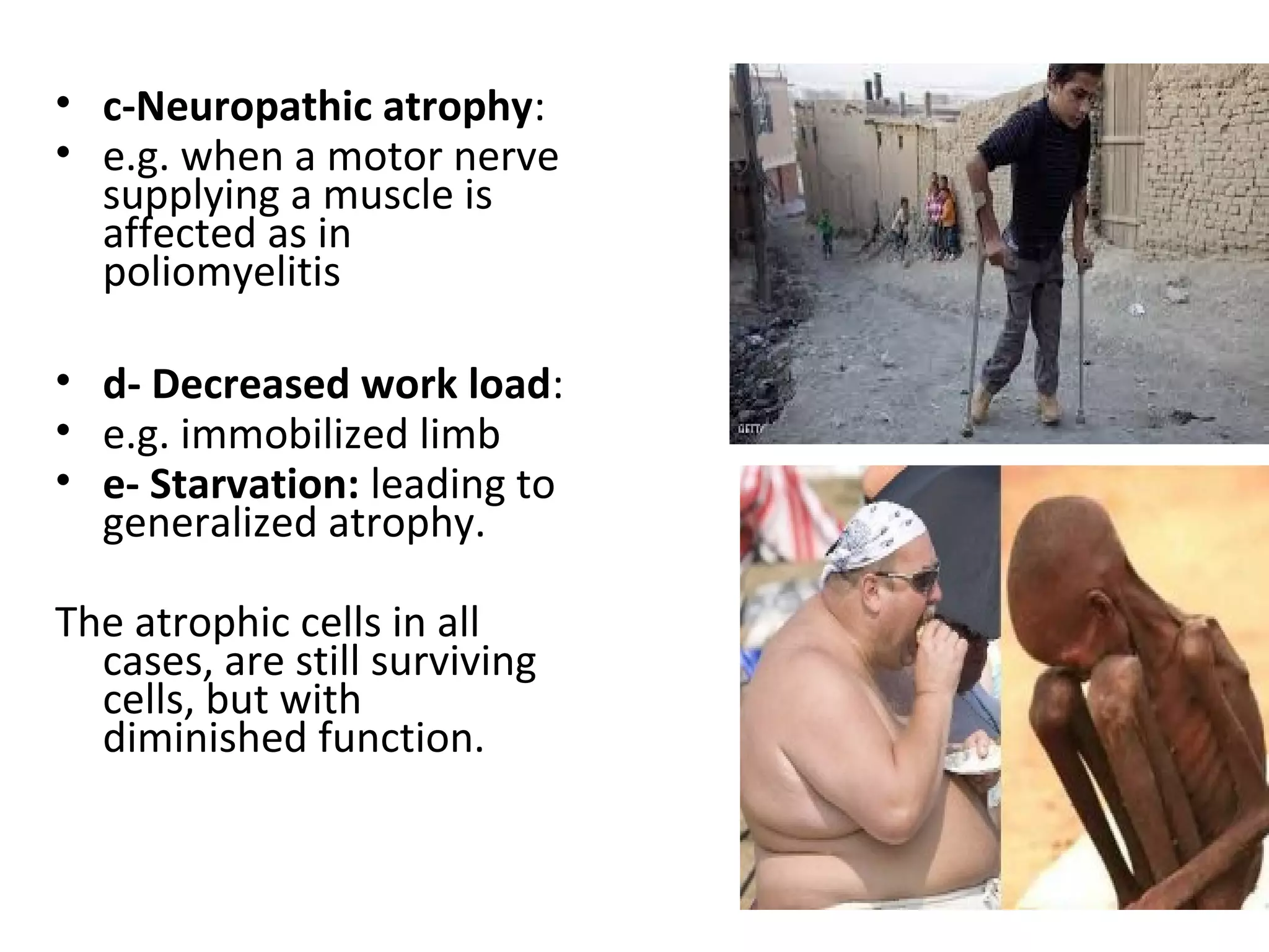 • c-Neuropathic atrophy:
• e.g. when a motor nerve
supplying a muscle is
affected as in
poliomyelitis
• d- Decreased work load:
• e.g. immobilized limb
• e- Starvation: leading to
generalized atrophy.
The atrophic cells in all
cases, are still surviving
cells, but with
diminished function.
 