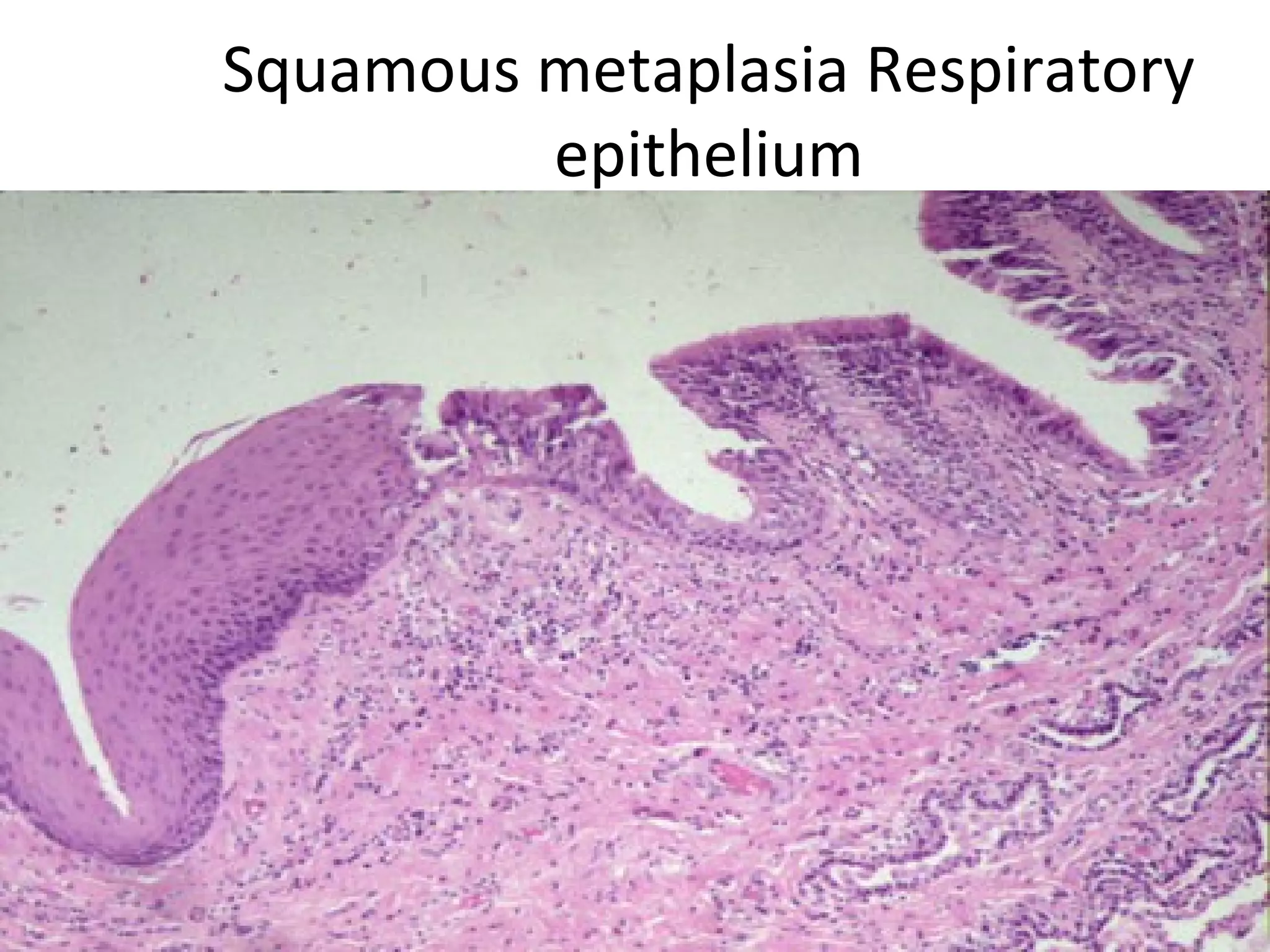 Squamous metaplasia Respiratory
epithelium
 