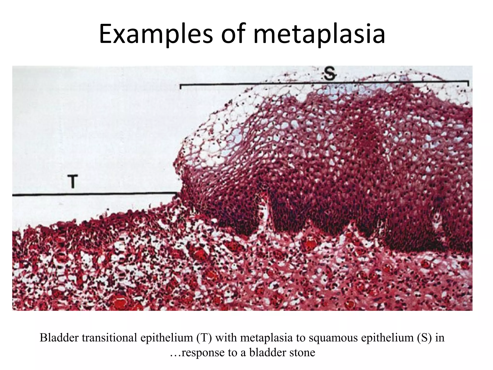 Examples of metaplasia
Bladder transitional epithelium (T) with metaplasia to squamous epithelium (S) in
response to a bladder stone…
 