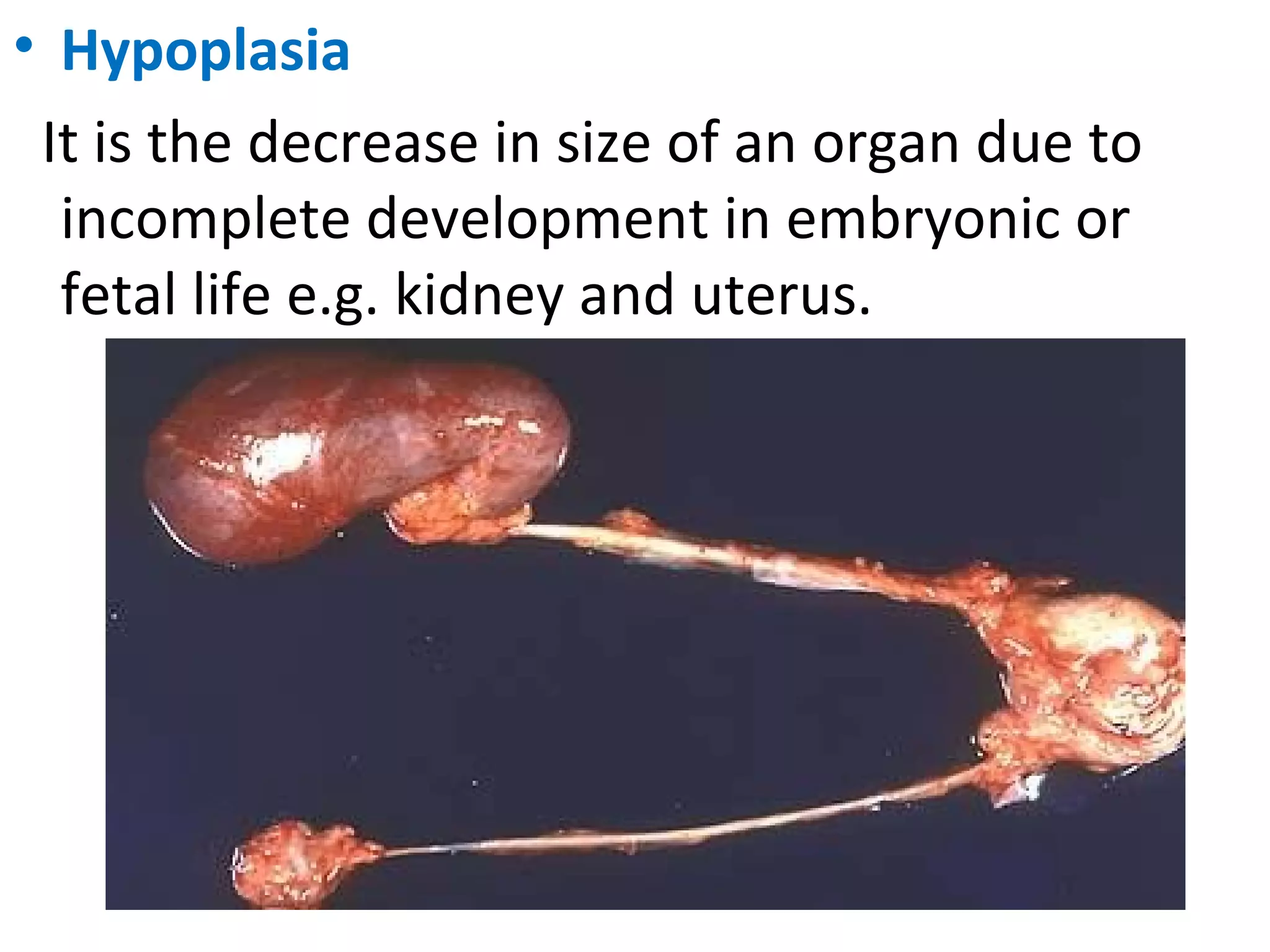 • Hypoplasia
It is the decrease in size of an organ due to
incomplete development in embryonic or
fetal life e.g. kidney and uterus.
 