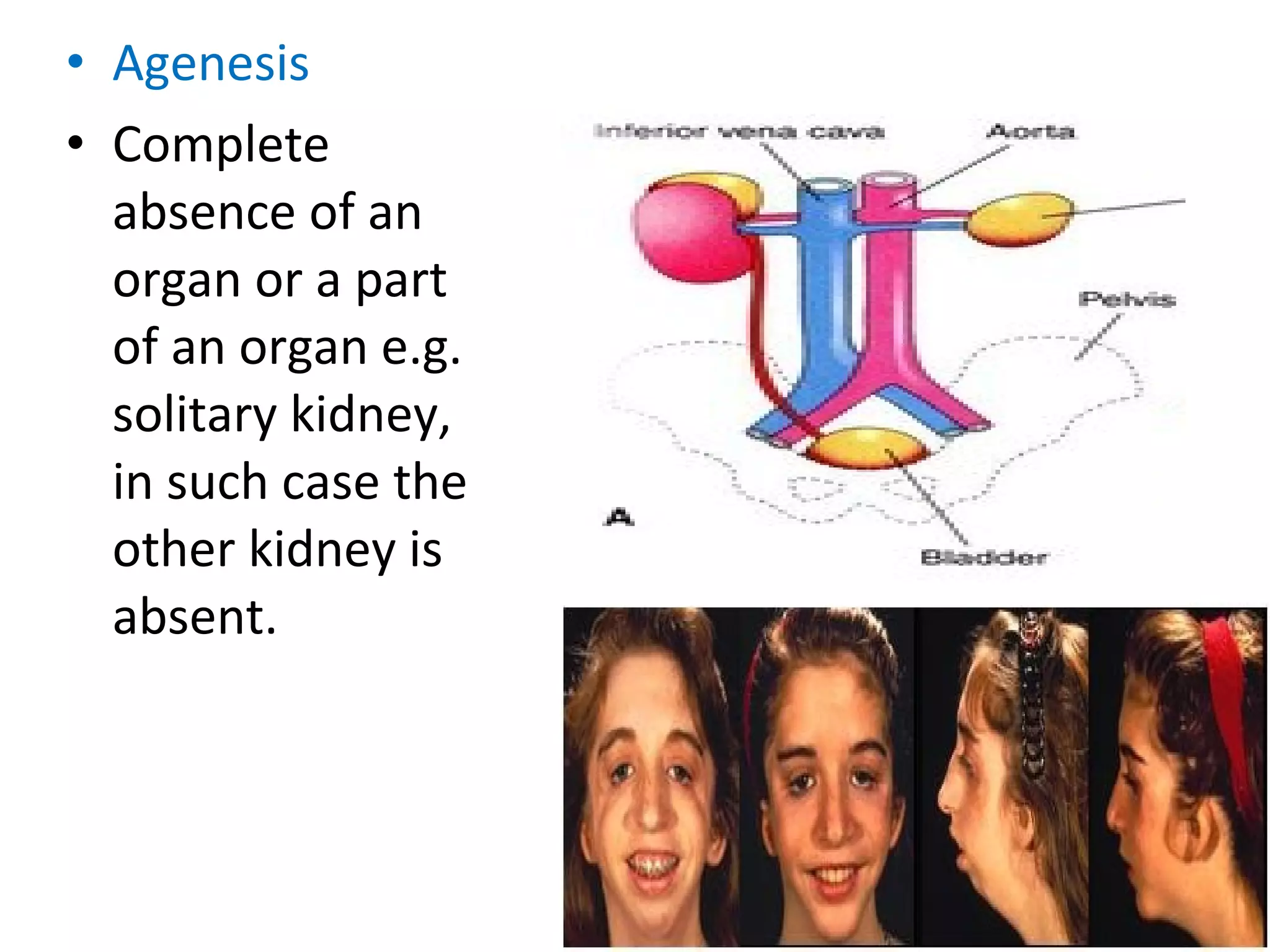 • Agenesis
• Complete
absence of an
organ or a part
of an organ e.g.
solitary kidney,
in such case the
other kidney is
absent.
 