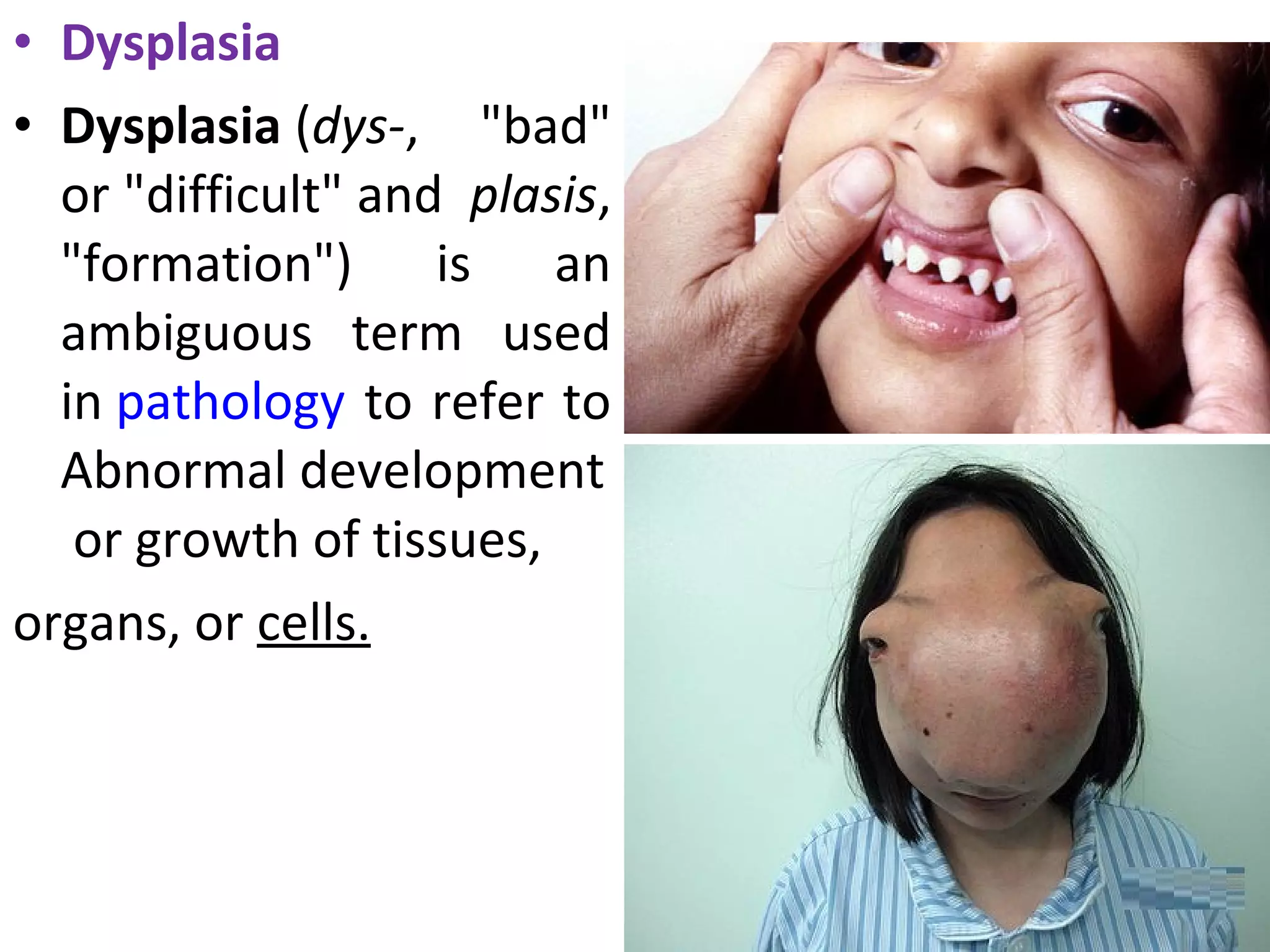 • Dysplasia
• Dysplasia (dys-, "bad"
or "difficult" and plasis,
"formation") is an
ambiguous term used
in pathology to refer to
Abnormal development
or growth of tissues,
organs, or cells.
 