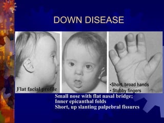 Lecture 2 Chromosomal diseases (1).ppt