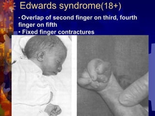 Lecture 2 Chromosomal diseases (1).ppt