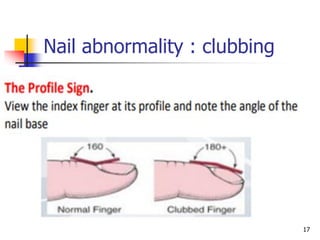 Nail Clubbing Algorithm Comprehensive Health Assessment and Head & Neck Examination Techniques ...