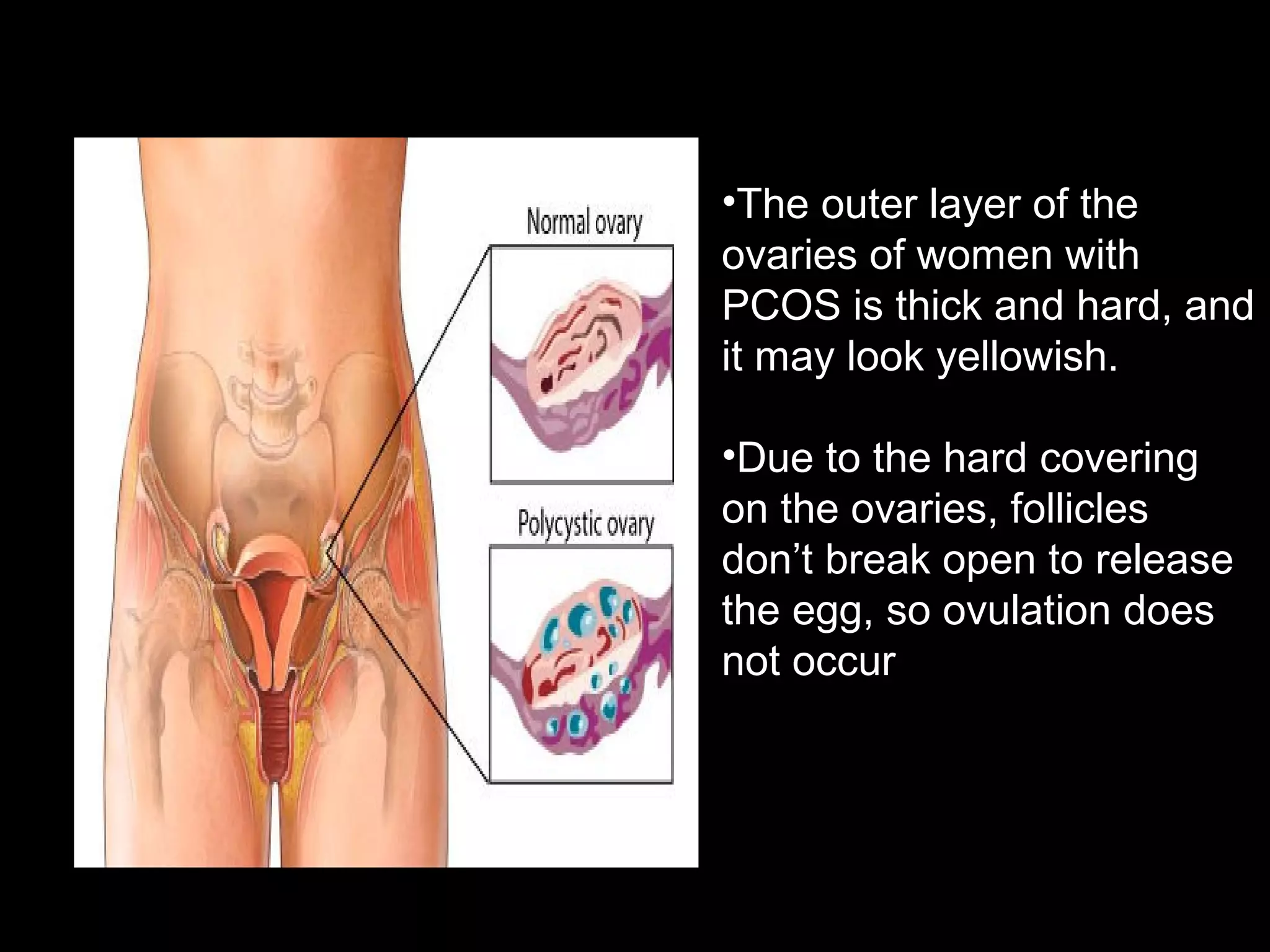 •The outer layer of the
ovaries of women with
PCOS is thick and hard, and
it may look yellowish.
•Due to the hard covering
on the ovaries, follicles
don’t break open to release
the egg, so ovulation does
not occur
 