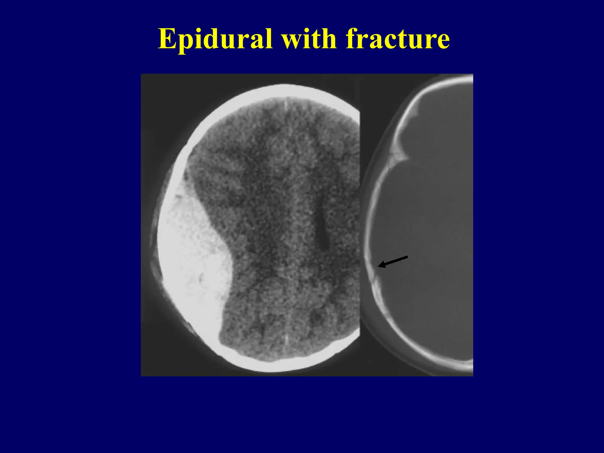 Epidural with fracture
 
