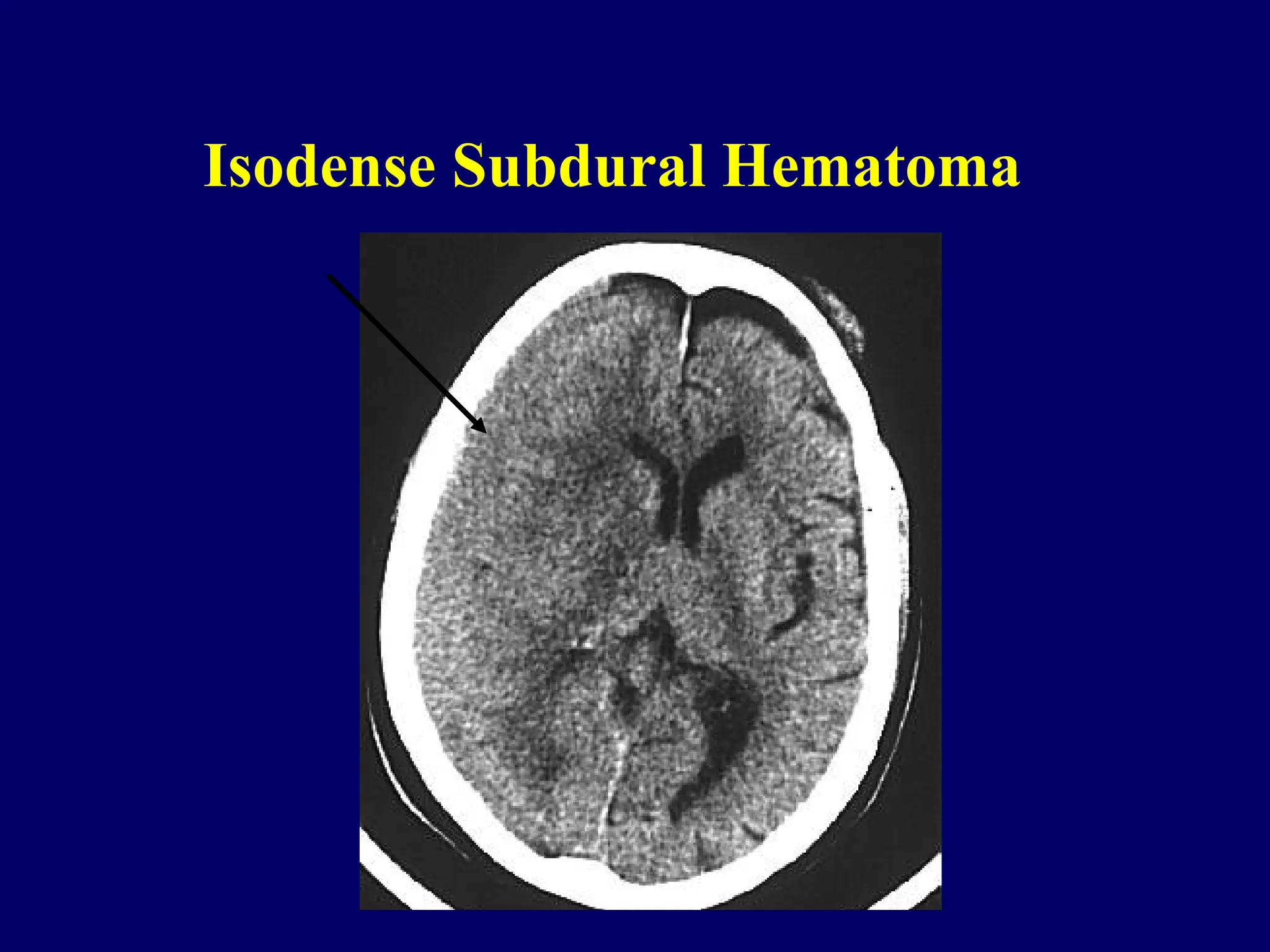 Isodense Subdural Hematoma
 