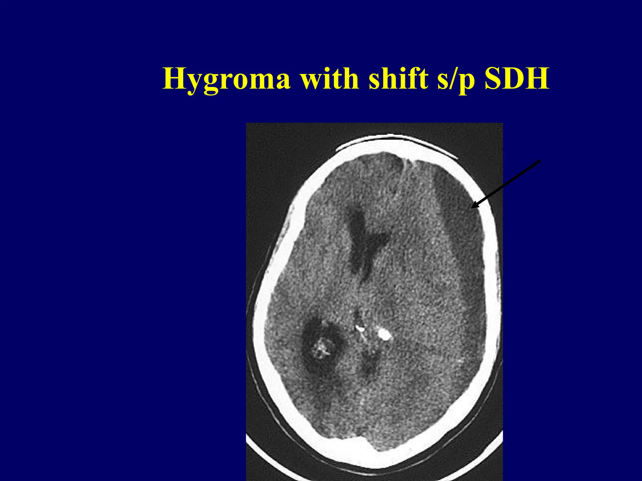 Hygroma with shift s/p SDH
 