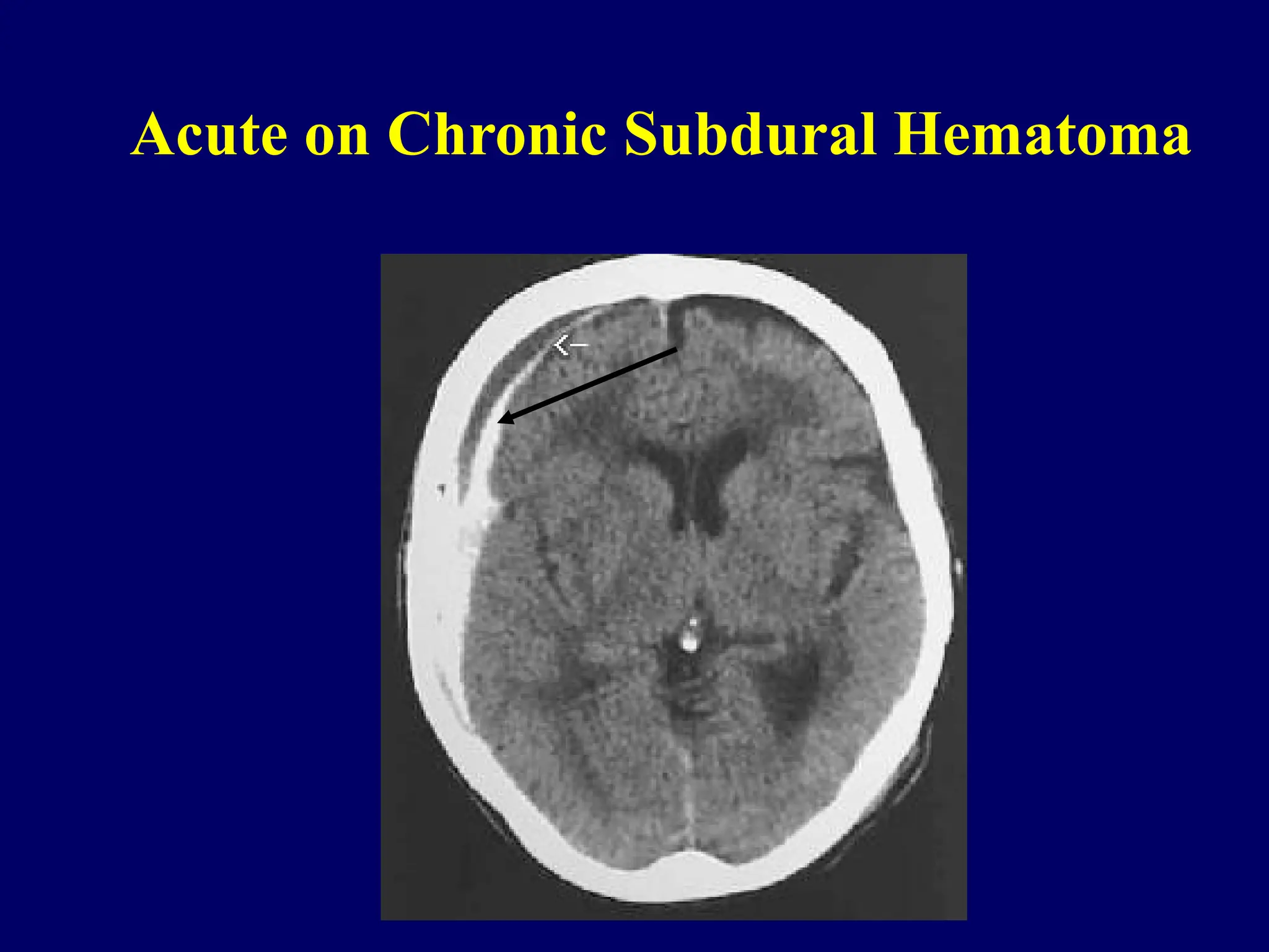 Acute on Chronic Subdural Hematoma
 