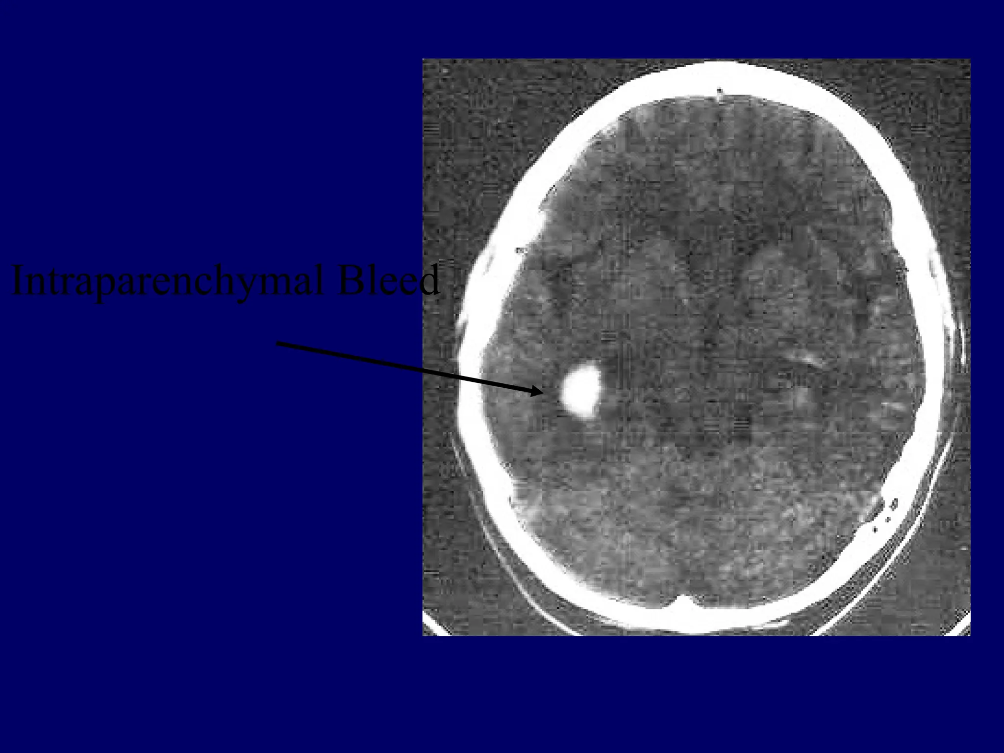 Intraparenchymal Bleed
 