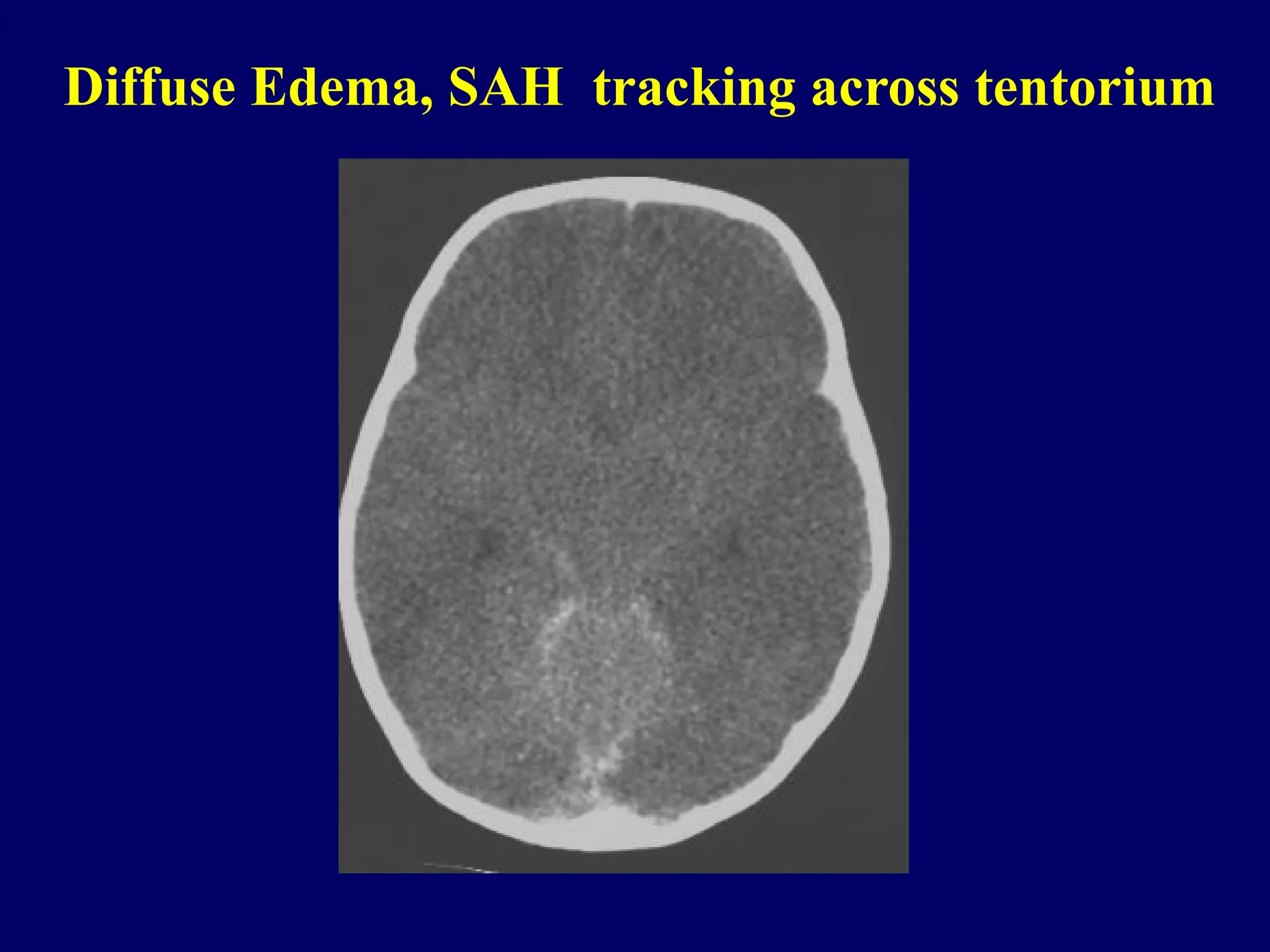 Diffuse Edema, SAH tracking across tentorium
 