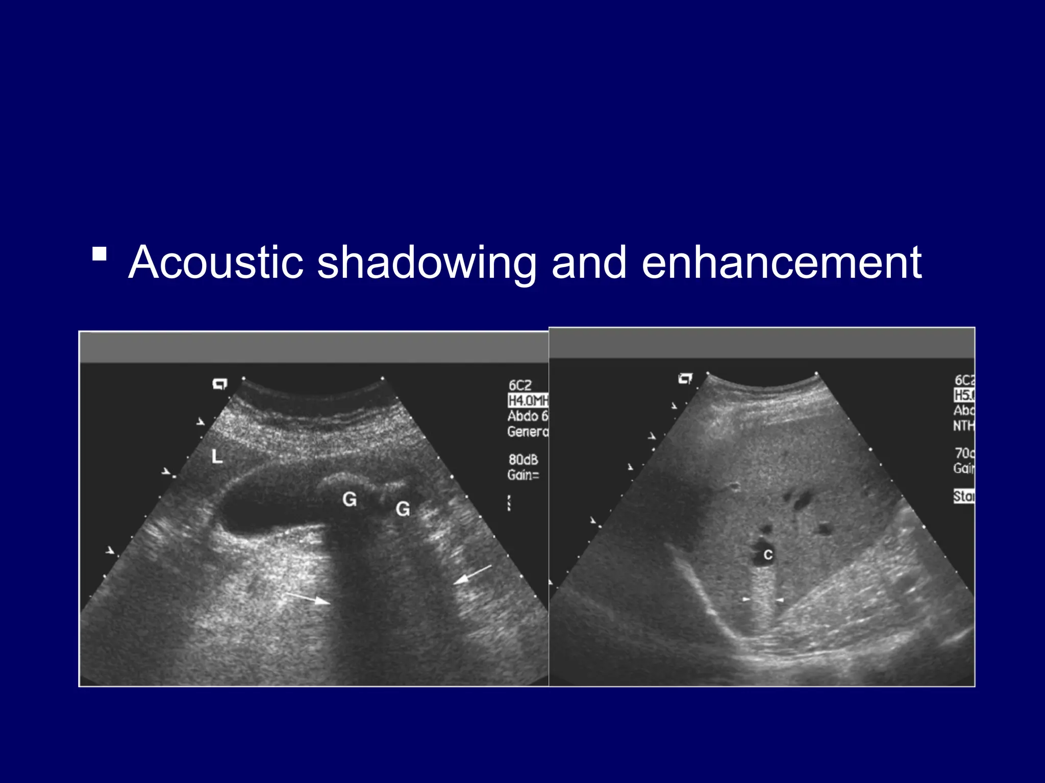  Acoustic shadowing and enhancement
 