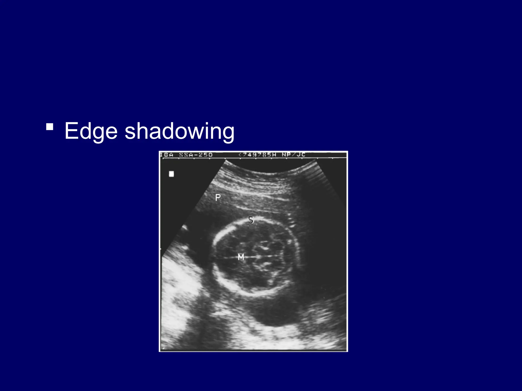  Edge shadowing
 