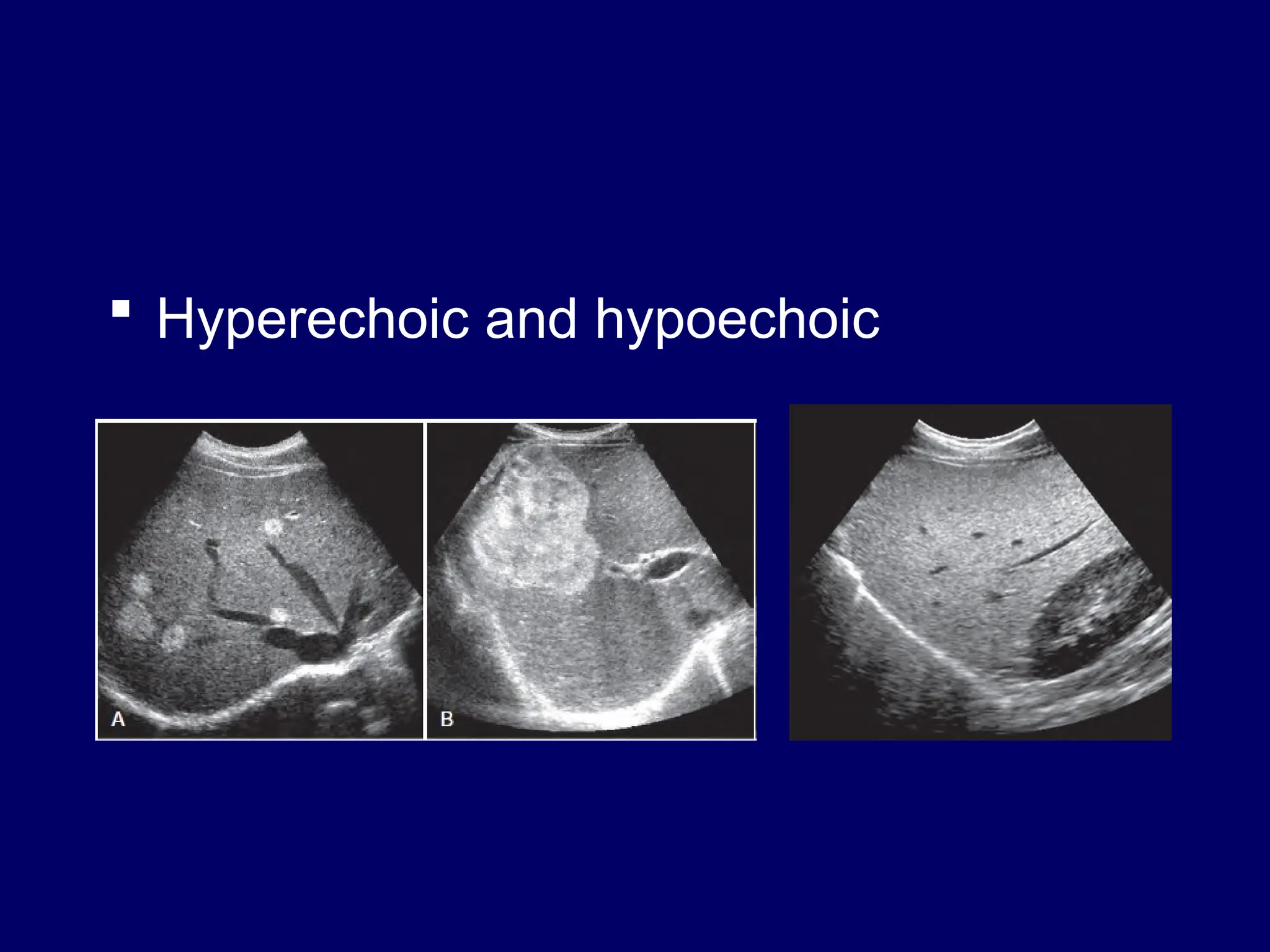  Hyperechoic and hypoechoic
 