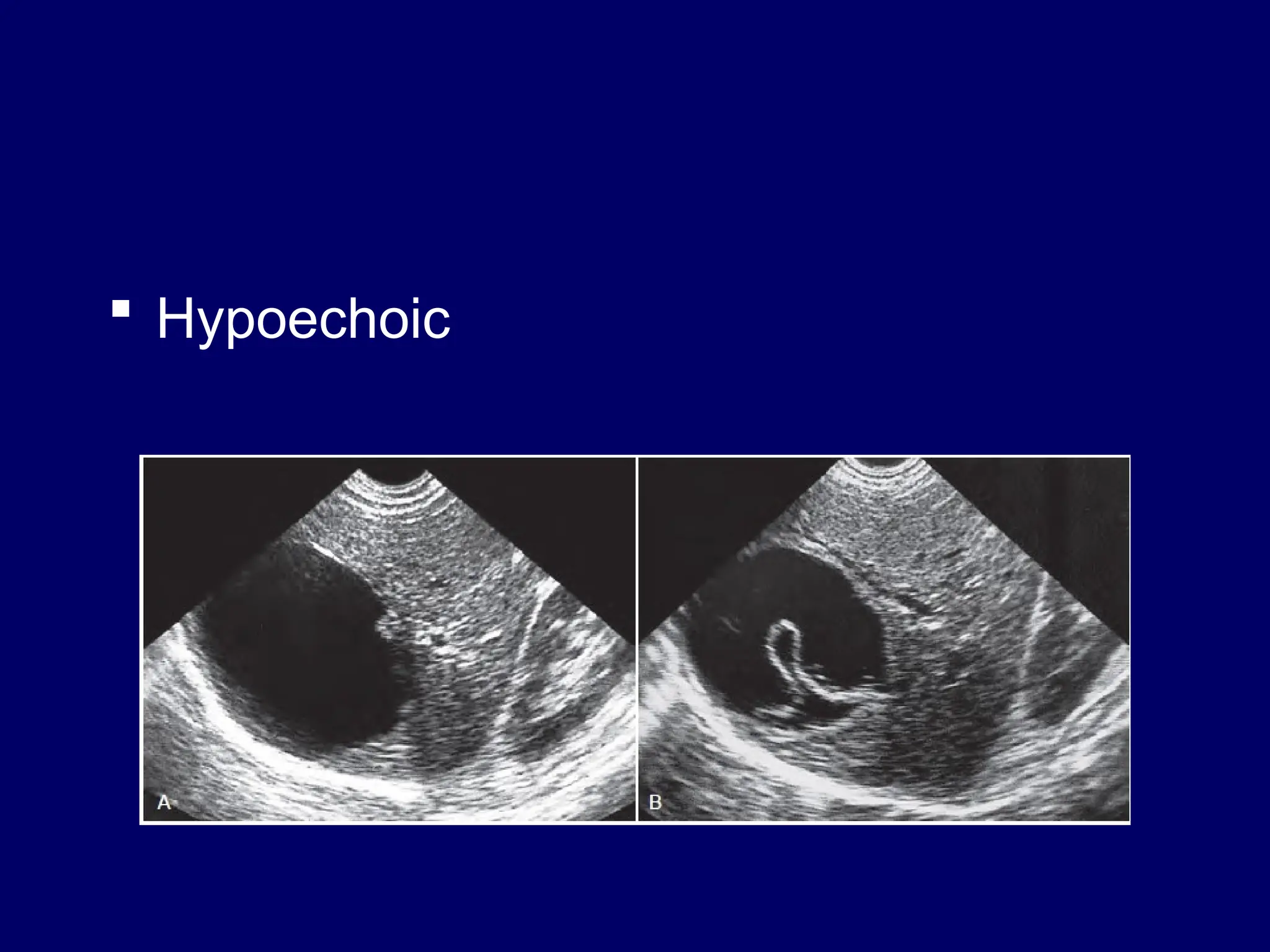  Hypoechoic
 