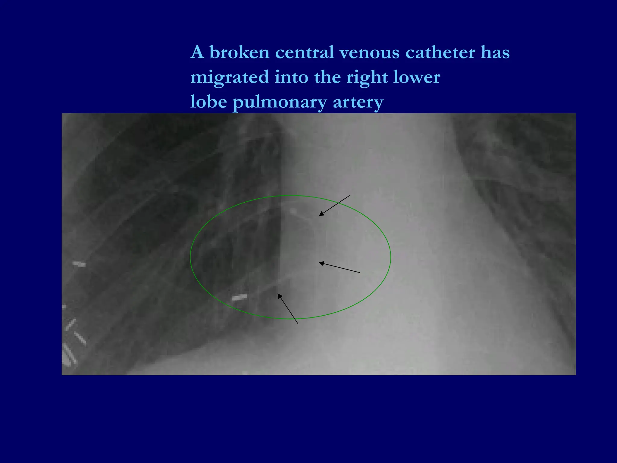 A broken central venous catheter has
migrated into the right lower
lobe pulmonary artery
 