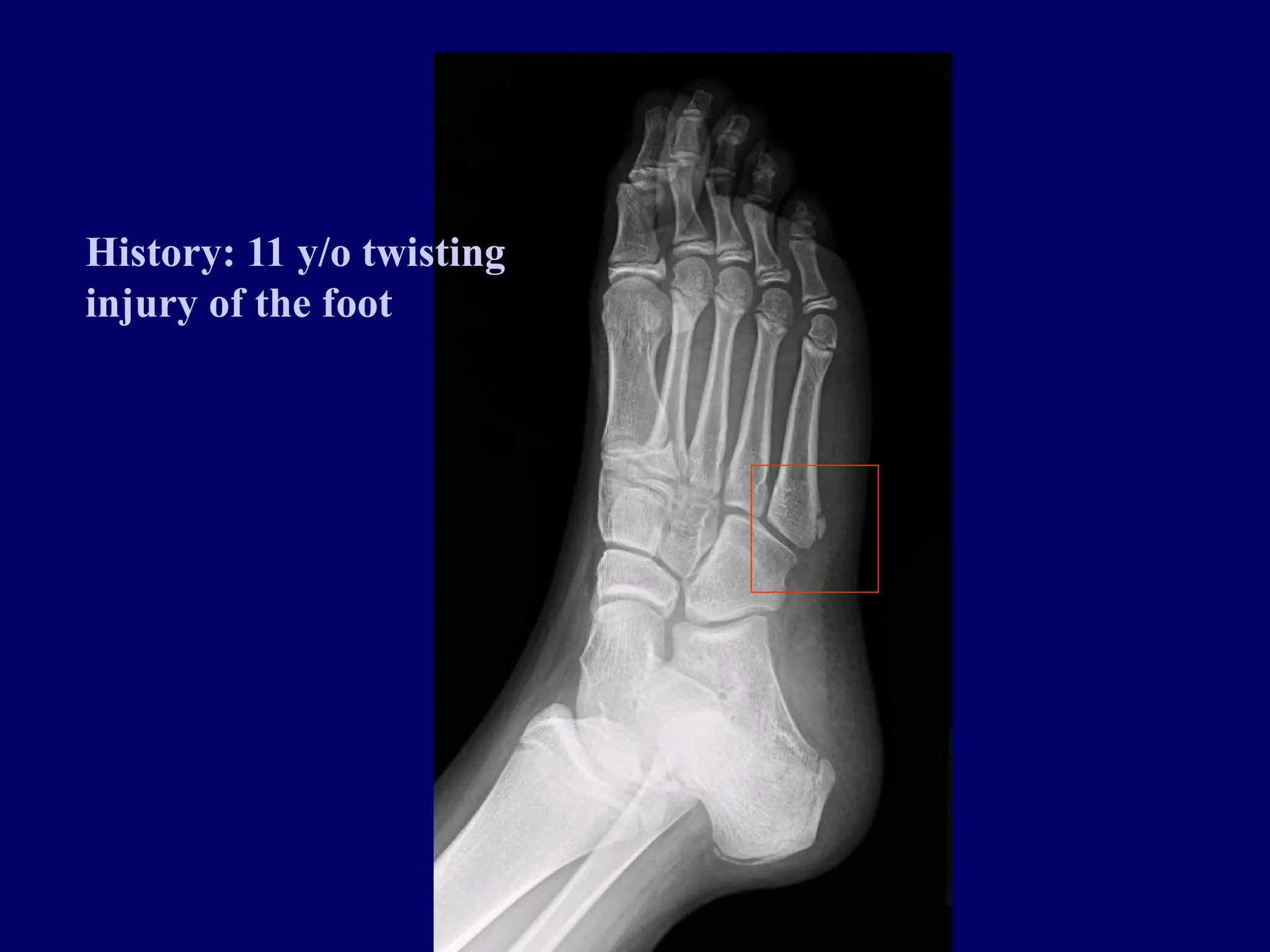 History: 11 y/o twisting
injury of the foot
 