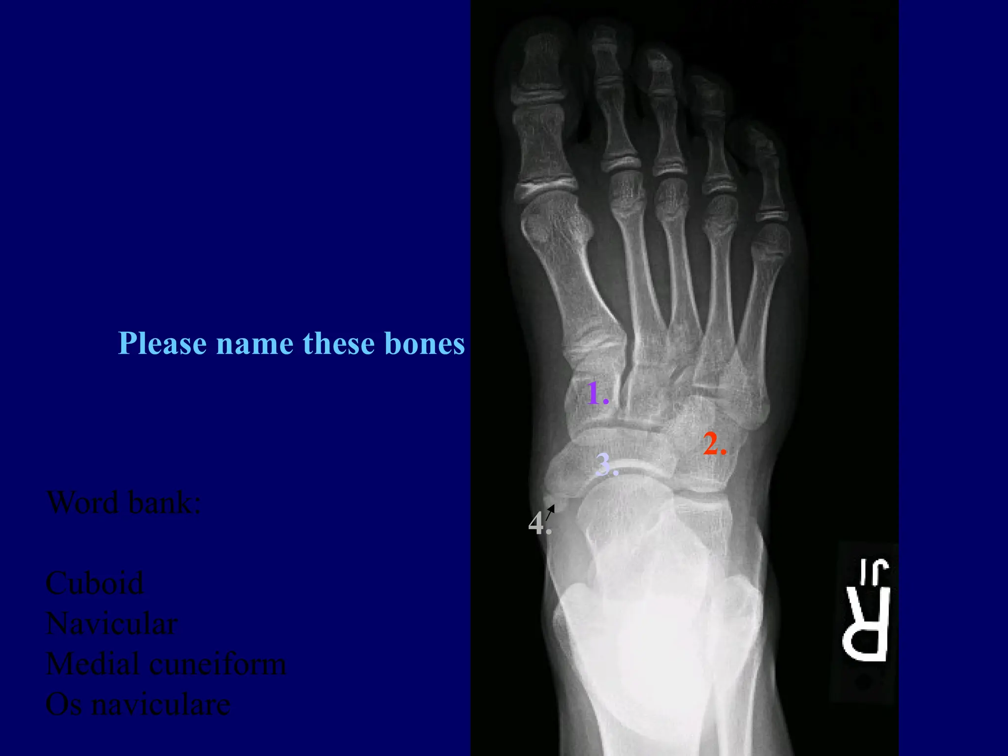 1.
2.
3.
4.
Please name these bones
Word bank:
Cuboid
Navicular
Medial cuneiform
Os naviculare
 