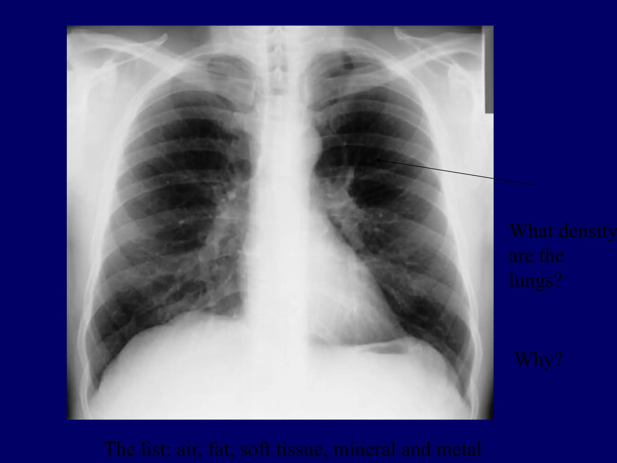 What density
are the
lungs?
Why?
The list: air, fat, soft tissue, mineral and metal
 