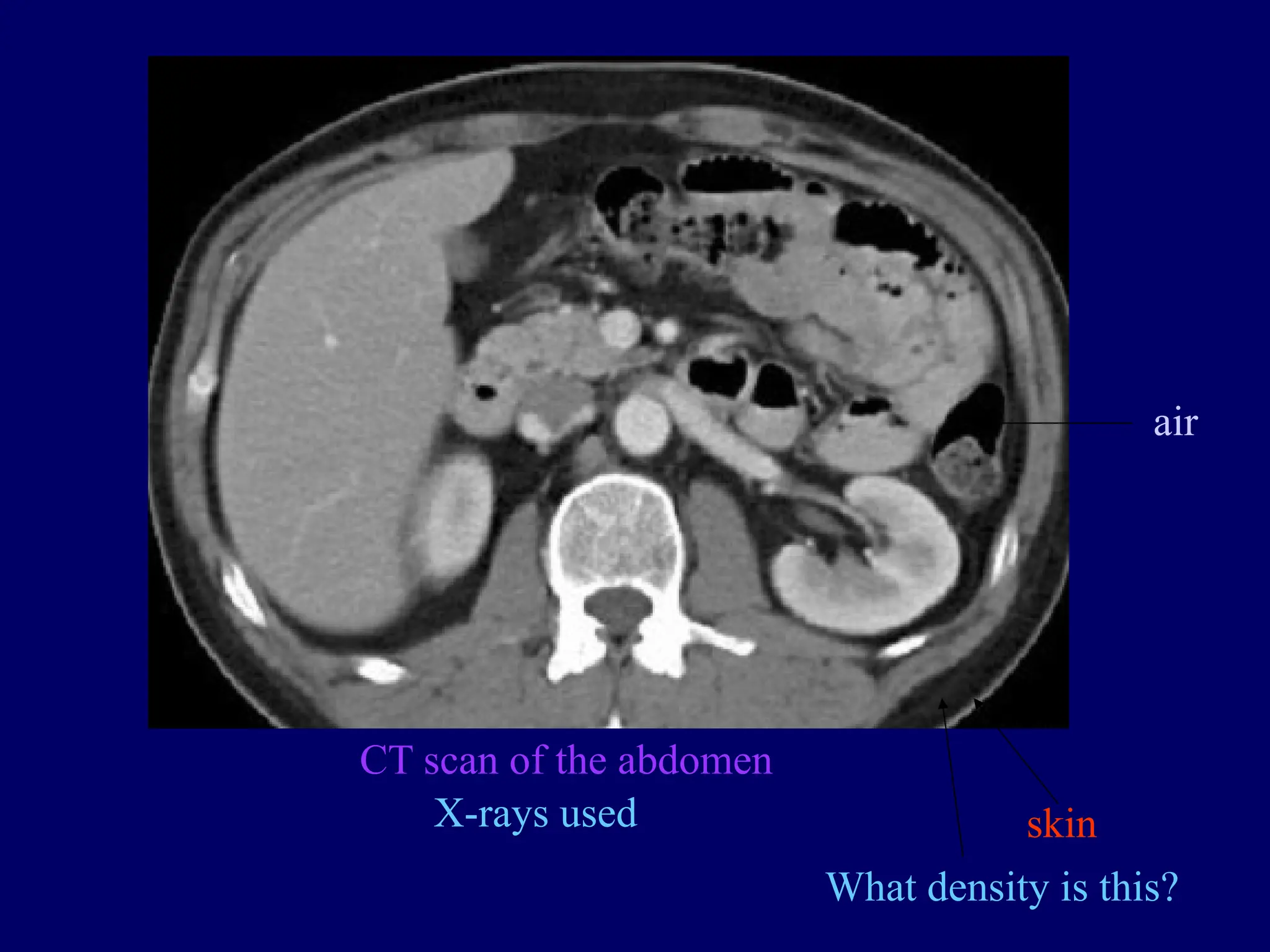 CT scan of the abdomen
X-rays used skin
What density is this?
air
 