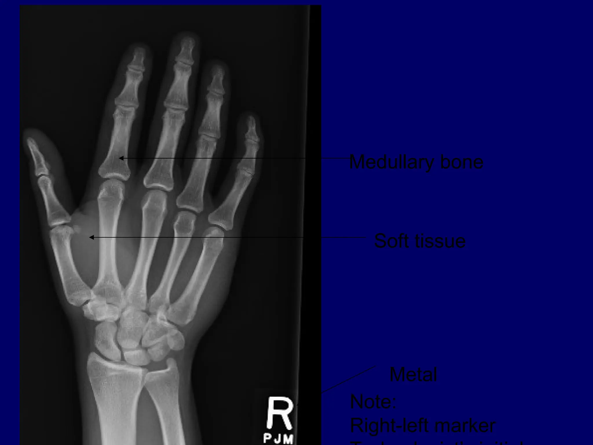 Medullary bone
Soft tissue
Metal
Note:
Right-left marker
 