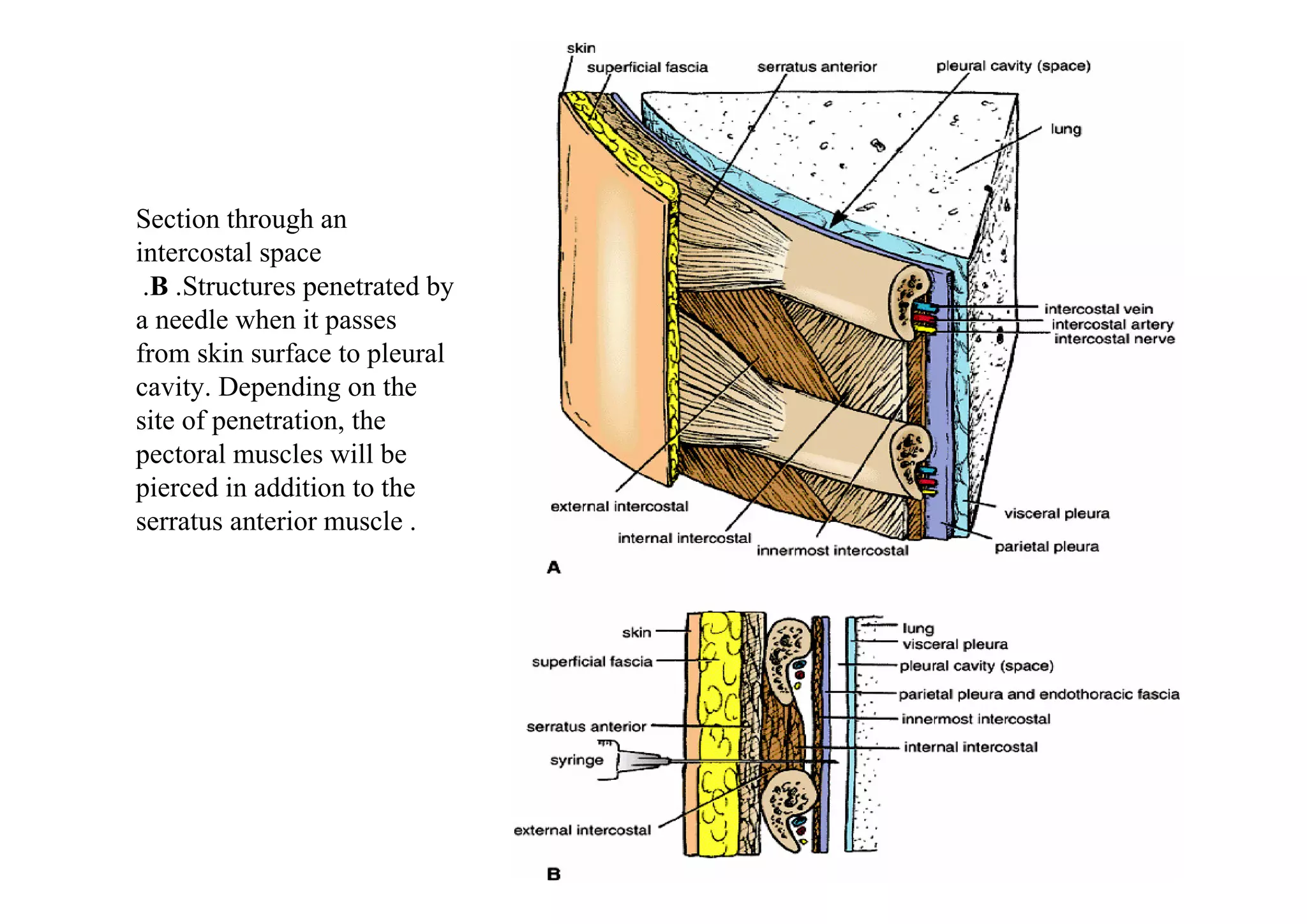 Section through an
intercostal space
 .B .Structures penetrated by
a needle when it passes
from skin surface to pleural
cavity. Depending on the
site of penetration, the
pectoral muscles will be
pierced in addition to the
serratus anterior muscle .
 