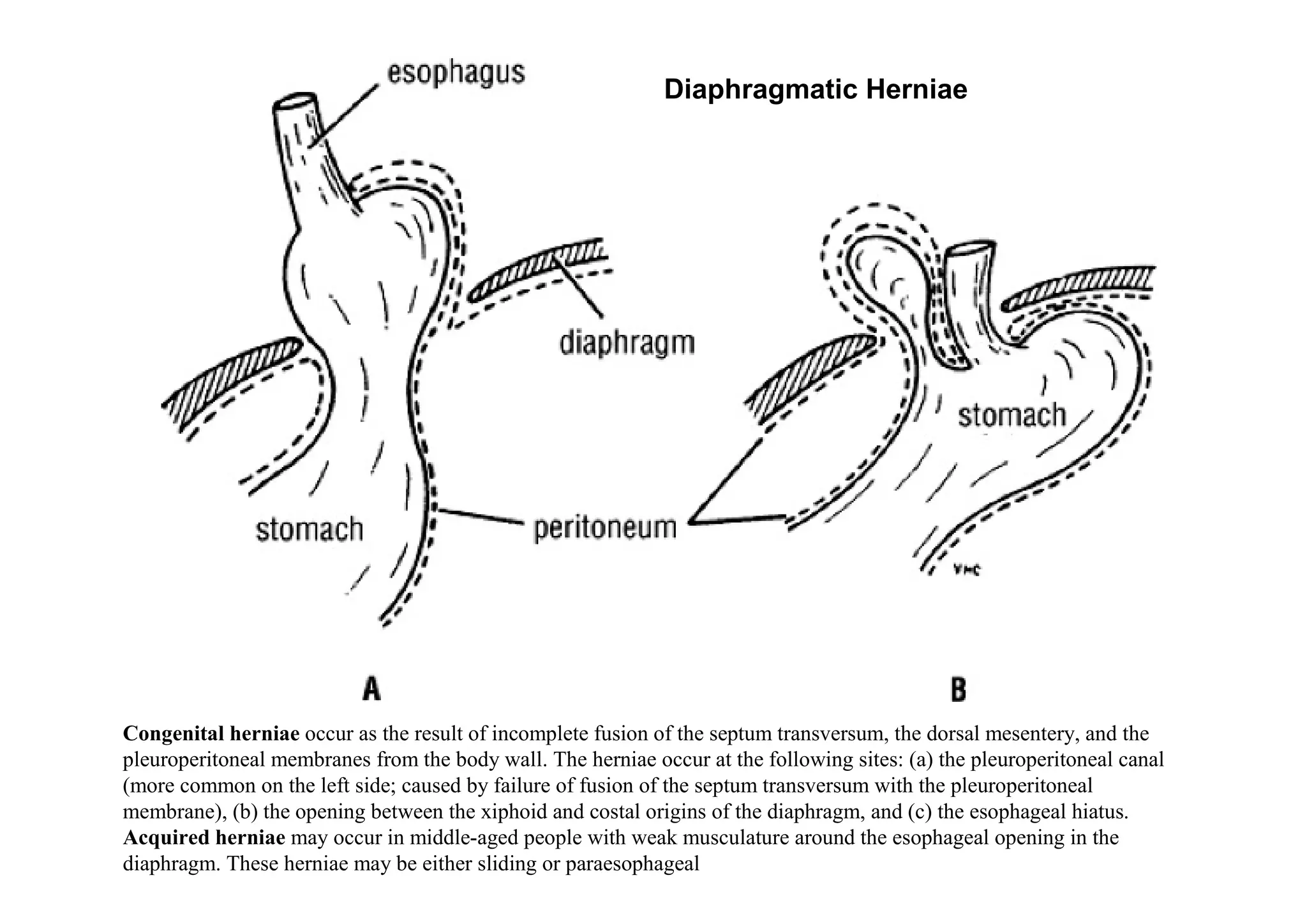 Diaphragmatic Herniae




Congenital herniae occur as the result of incomplete fusion of the septum transversum, the dorsal mesentery, and the
pleuroperitoneal membranes from the body wall. The herniae occur at the following sites: (a) the pleuroperitoneal canal
(more common on the left side; caused by failure of fusion of the septum transversum with the pleuroperitoneal
membrane), (b) the opening between the xiphoid and costal origins of the diaphragm, and (c) the esophageal hiatus.
Acquired herniae may occur in middle-aged people with weak musculature around the esophageal opening in the
diaphragm. These herniae may be either sliding or paraesophageal
 