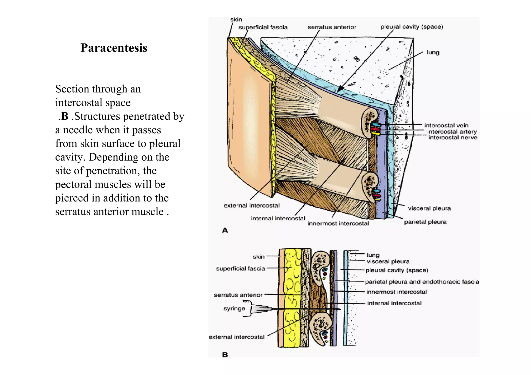 Paracentesis


Section through an
intercostal space
 .B .Structures penetrated by
a needle when it passes
from skin surface to pleural
cavity. Depending on the
site of penetration, the
pectoral muscles will be
pierced in addition to the
serratus anterior muscle .
 