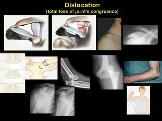 Lecture 2 - Injuries of upper extremity | PPTX