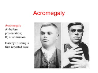 Acromegaly
Acromegaly
A) before
presentation;
B) at admission
Harvey Cushing’s
first reported case

 