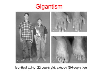 Gigantism

Identical twins, 22 years old, excess GH secretion

 