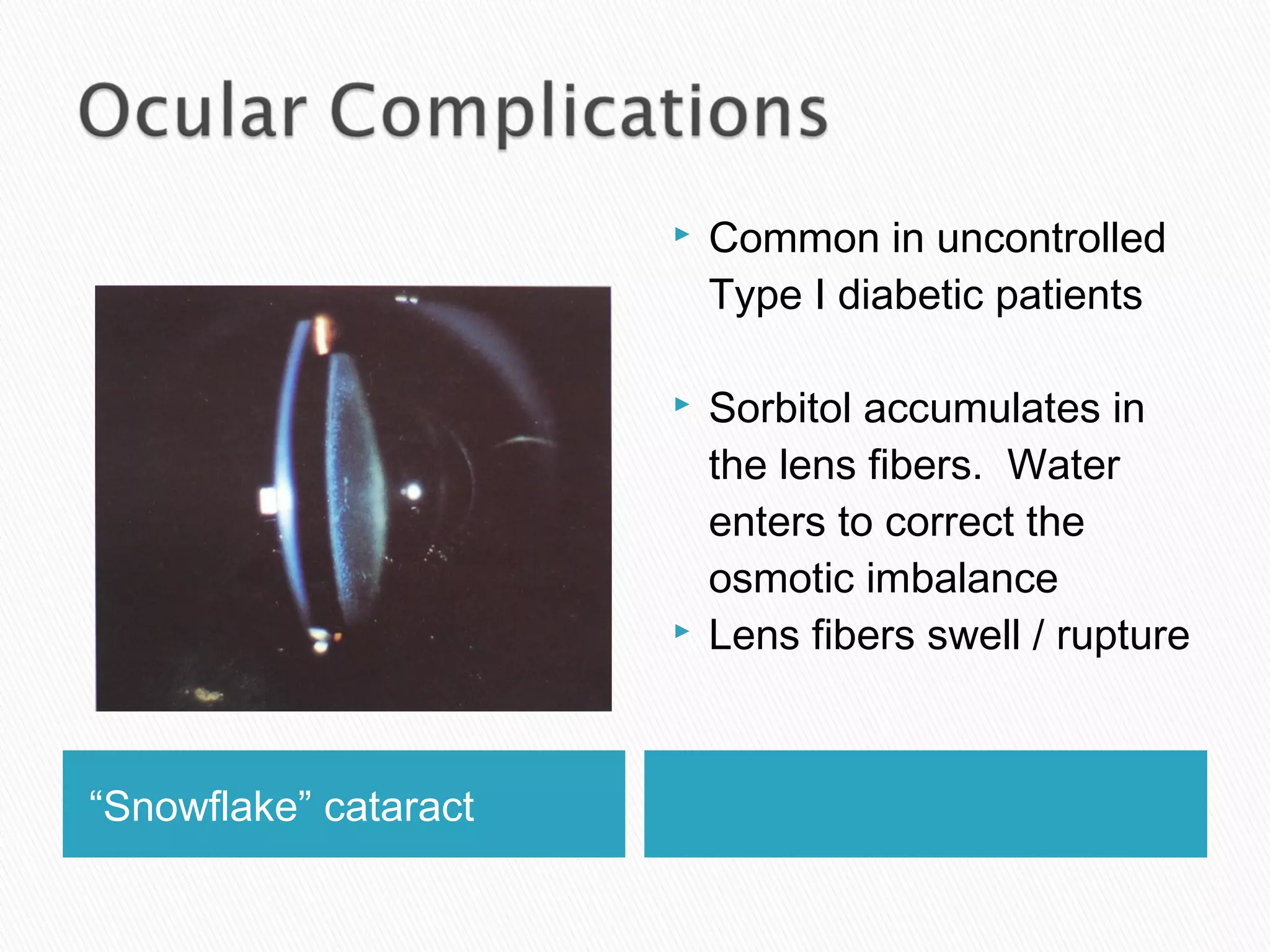 “Snowflake” cataract
 Common in uncontrolled
Type I diabetic patients
 Sorbitol accumulates in
the lens fibers. Water
enters to correct the
osmotic imbalance
 Lens fibers swell / rupture
 