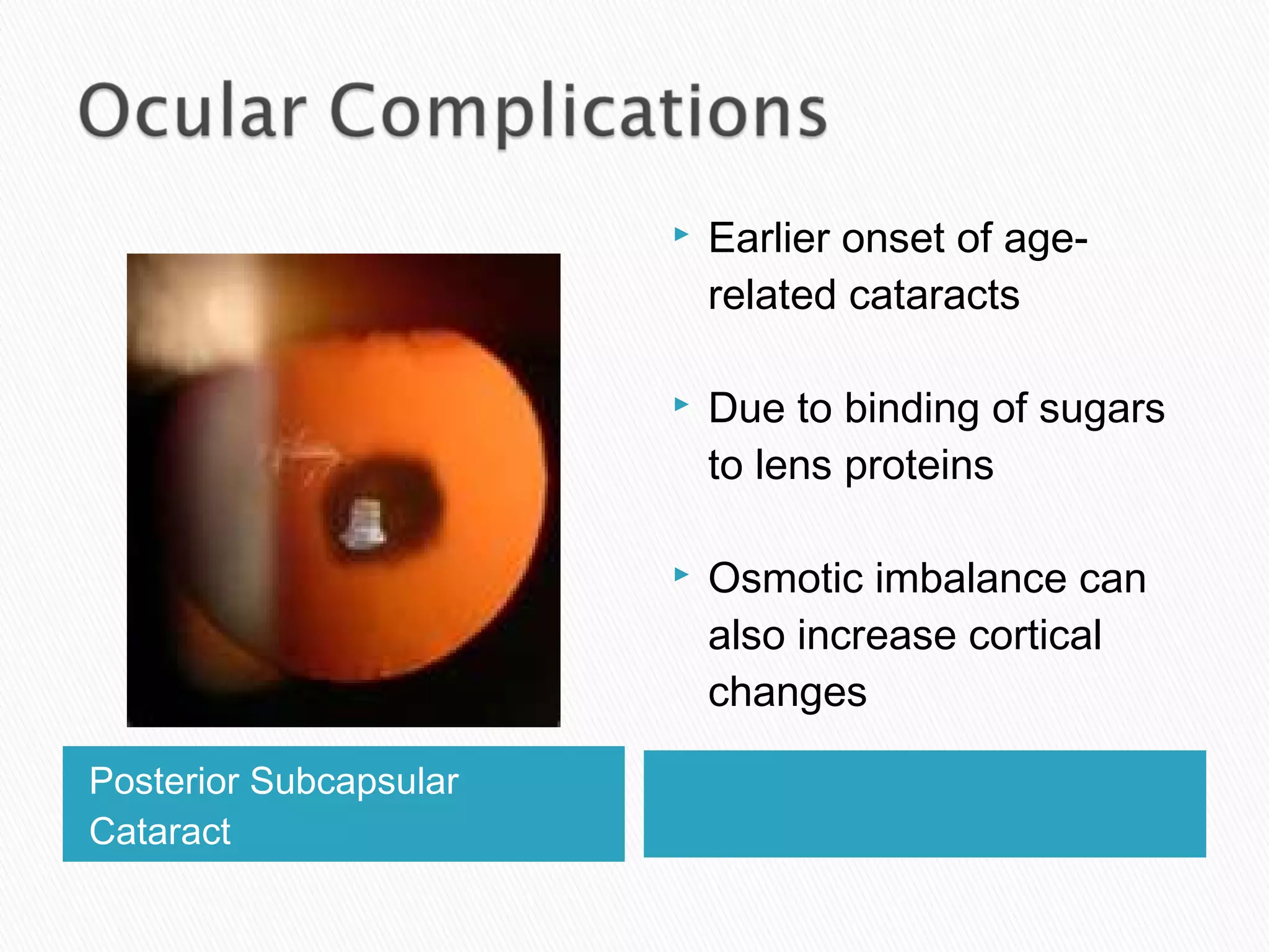 Posterior Subcapsular
Cataract
 Earlier onset of age-
related cataracts
 Due to binding of sugars
to lens proteins
 Osmotic imbalance can
also increase cortical
changes
 