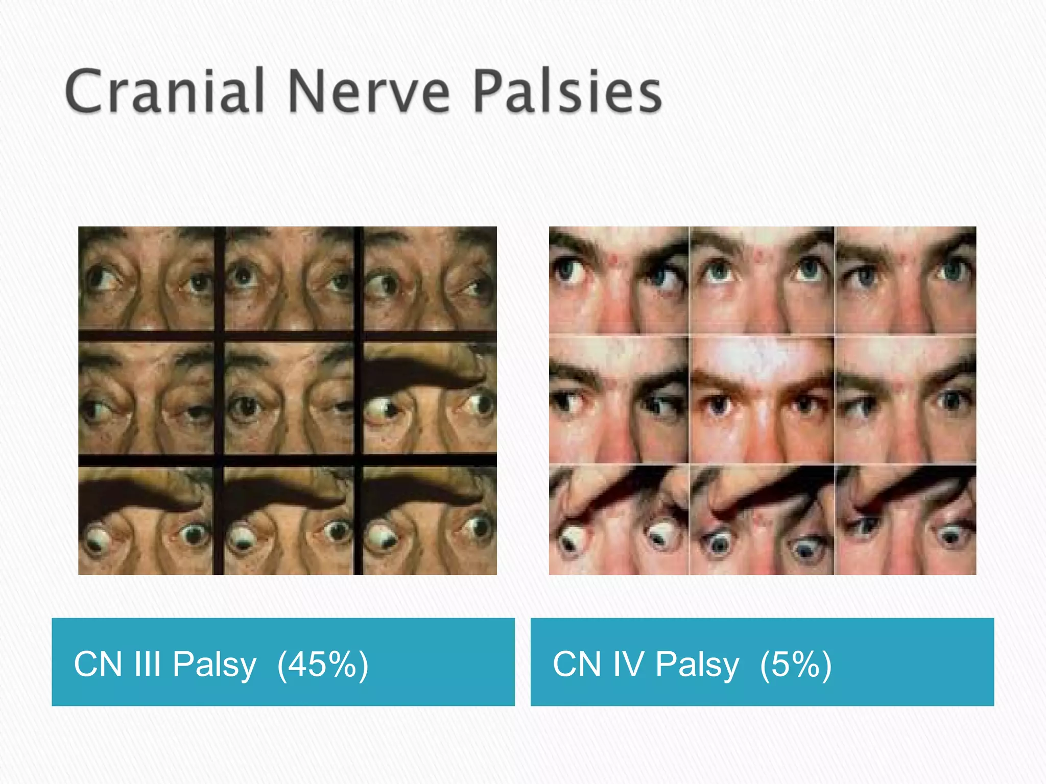 CN III Palsy (45%) CN IV Palsy (5%)
 