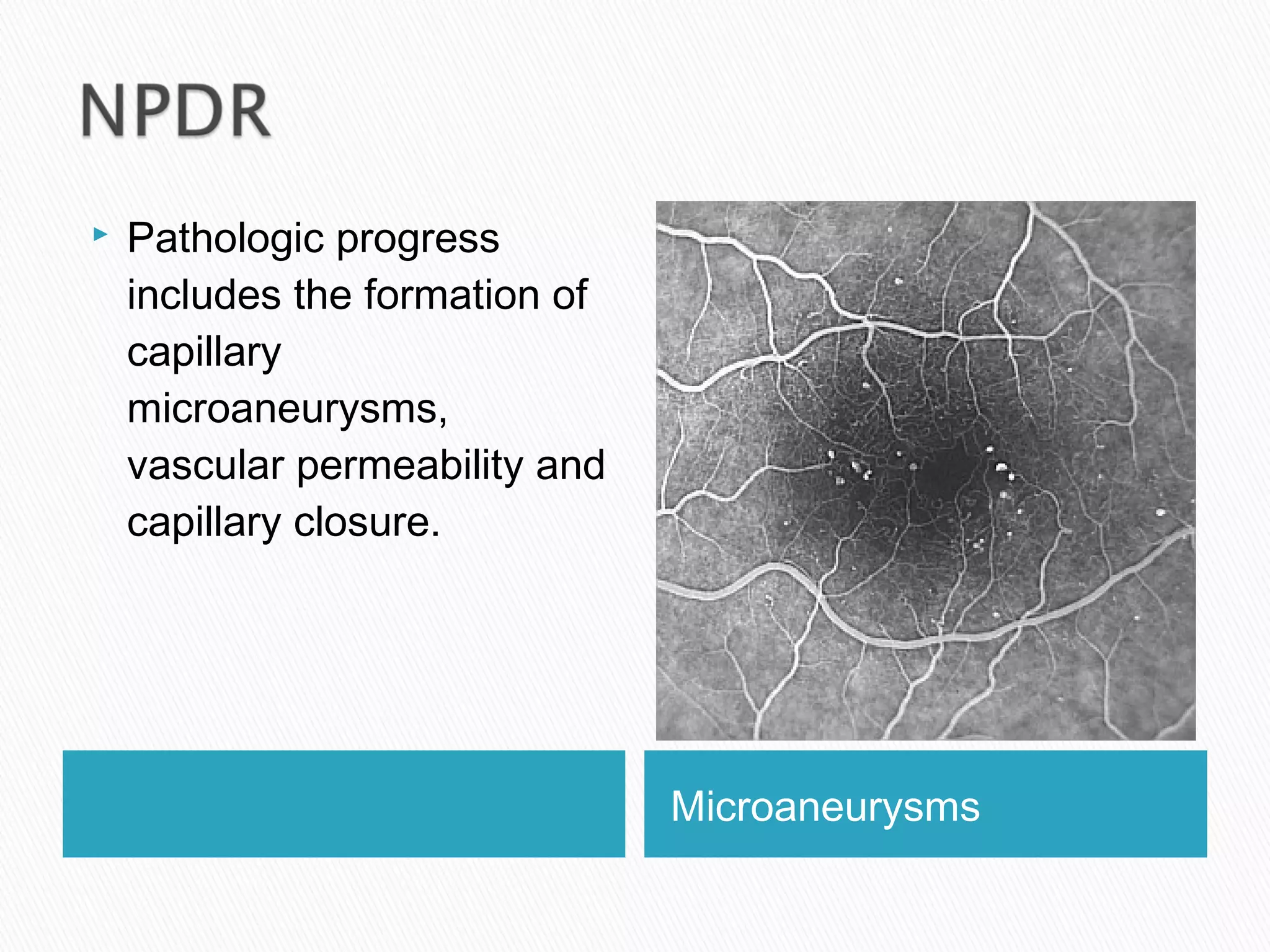 Microaneurysms
 Pathologic progress
includes the formation of
capillary
microaneurysms,
vascular permeability and
capillary closure.
 