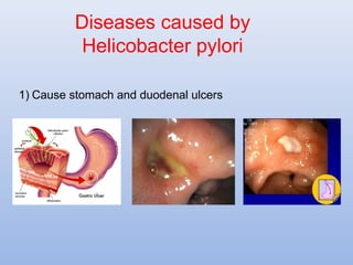 Diseases caused by 
Helicobacter pylori 
1) Cause stomach and duodenal ulcers 
 