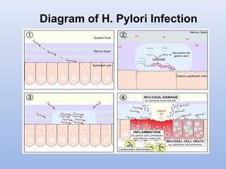 Diagram of H. Pylori Infection 
 