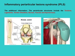 Inflammatory periarticular lesions syndrome (IPLS)
The additional information. The periarticular structures include the Tendons,
Ligaments, Tendon Sheathes, Bursas, Fascias and Aponevrosis.
 