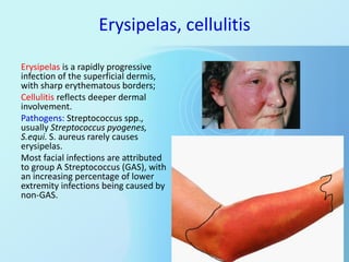 Erysipelas, cellulitis
Erysipelas is a rapidly progressive
infection of the superficial dermis,
with sharp erythematous bo...