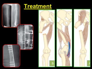 Lecture 3 - Lower extremity injuries | PPTX