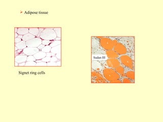  Adipose tissue

Sudan III

Signet ring cells

 