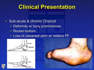 Clinical Presentation
• Sub-acute & chronic Charcot
• Deformity w/ bony prominences
• Rocker-bottom
• Loss of calcaneal pitch w/ relative PF
 