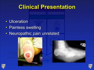 Clinical Presentation
• Ulceration
• Painless swelling
• Neuropathic pain unrelated
 