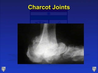 Charcot Joints
 