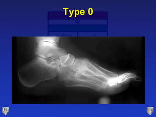 Type 0
 
